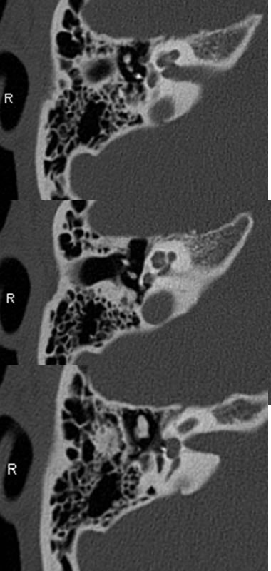 Otosclerosis